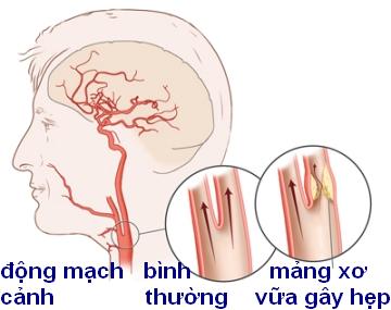 Nhận biết sớm bệnh thiếu máu não 
